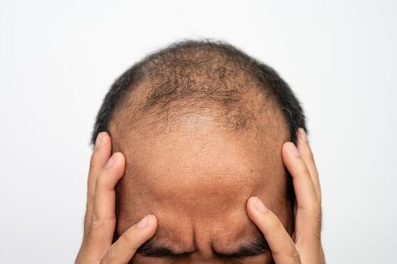 غذای ما و ریزش مو !