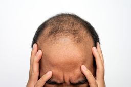 غذای ما و ریزش مو !